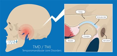 TMJ, Orofacial Pain, Headaches - Capstone Physical Therapy