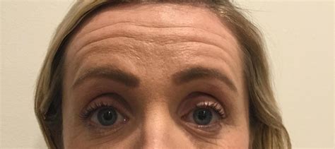 Forehead Lines Botox Procedure Chicago | Dr. Mick Singh Elysium