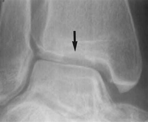 Osteochondritis Dissecans of the Tibial Plafond Imaging Characteristics ...
