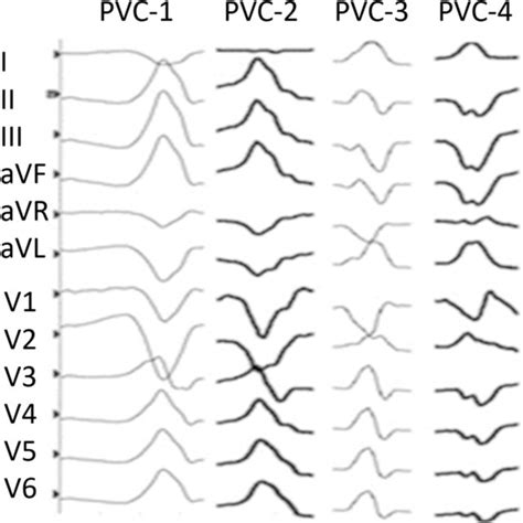 Image result for PVC Localization Chart