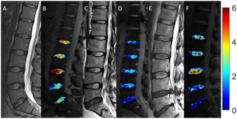 Non-Specific Low Back Pain and Lumbar Radiculopathy: Comparison of ...