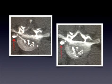 Image result for Disco Injection