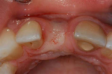 Extraction Site Bone Graft | Extraction Site Bone Graft - Kazemi Oral Surgery | Facialart.com