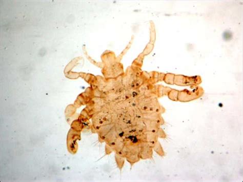 Spolna bolest: Pediculosis pubis ('stidne uši') – Hercegovina.in