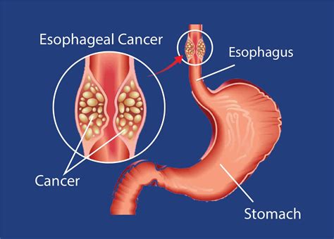 Esophageal Cancer: Causes, Types, Symptoms, Diagnosis, Treatment, and ...