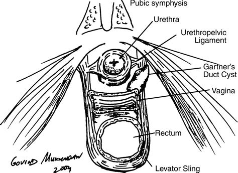 Female Urethra Lump at Steven Begay blog