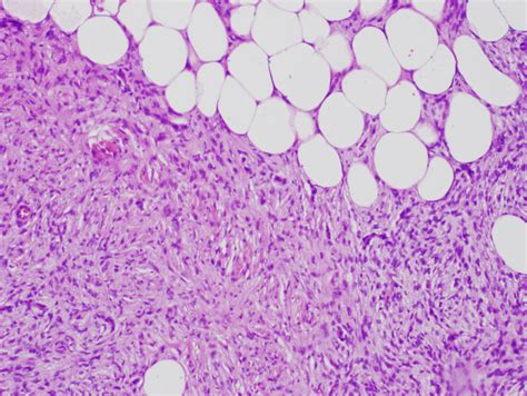 Image result for Dermatofibrosarcoma Protuberans