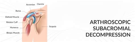 Image result for Subacromial Decompression Rotator Cuff Repair