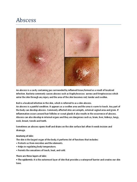 Infected Abscess Lanced 的图像结果