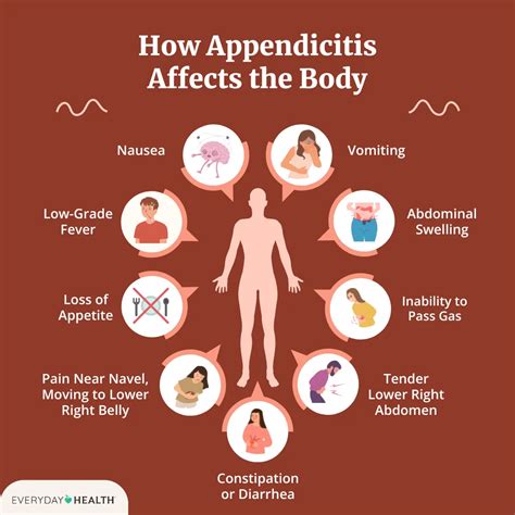 Appendicitis Medical Pictures Info Health Definitions Laparoscopic