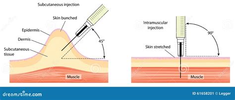 Intradermal vs Subcutaneous Injection 的图像结果