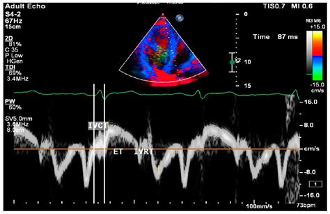 The Triglyceride–Glucose Index, a Marker of Insulin Resistance, Is ...