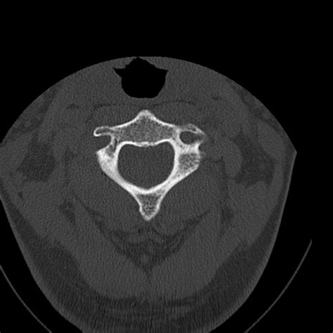 Occipital condyle fracture (Radiopaedia 31755-32691 Axial bone window ...