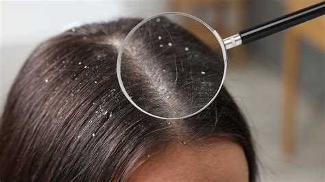 Amla Powder for Hair: Benefits, Uses & DIY Hair Masks