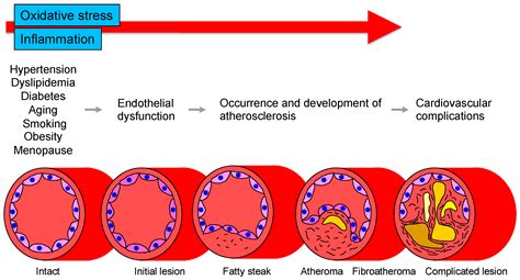 Roles of Oxidative Stress and Inflammation in Vascular Endothelial Dysfunction-Related Disease