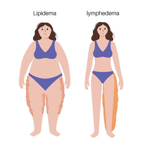 What is Lipedema? | Dr. Steff