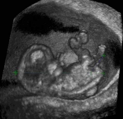 怀孕五十天照B超诊断宫内早孕可见卵黄囊未见胚芽 CDFI未见明显异常血流信号 这种情况有可能胎停育吗 - 百度宝宝知道