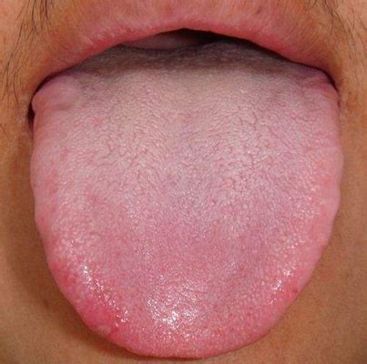 舌炎的症状图片 (8)_有来医生