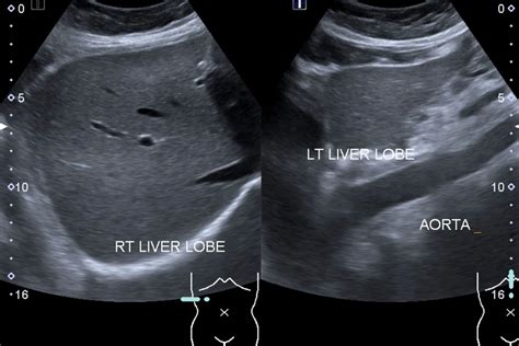 Liver Ultrasound: Procedure and Results