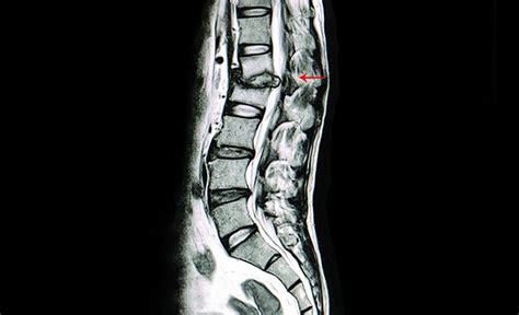Spine Specialist Delhi