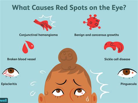 Red Eyeball Causes