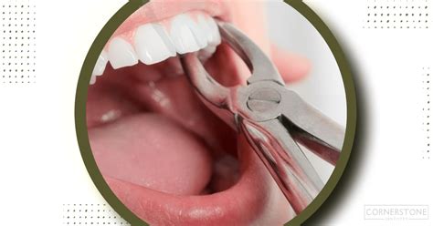Image result for Post Tooth Extraction