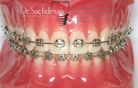 Metal Dental Braces Treatment Delhi India