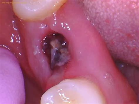 Tooth Socket After Extraction 的图像结果