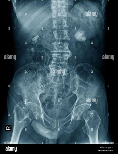 Renal calculus or kidney stone x-ray image in blue tone picture Stock Photo - Alamy