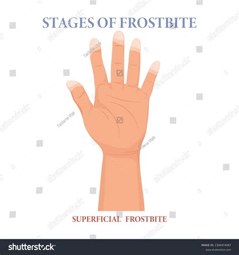 Vector Frozen Hands With Fingers. Medical Frostbite. Skin Burn Symptom. Vector Illustration ...