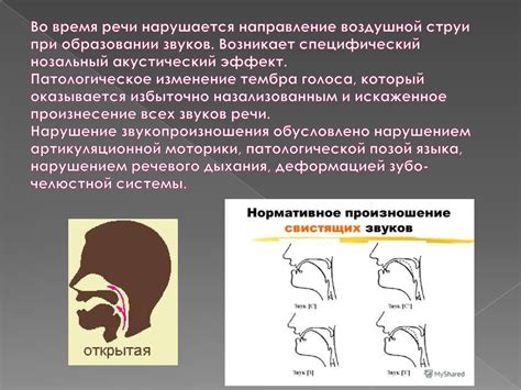Произношение свистящих звуков при открытой ринолалии - online presentation