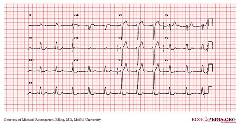Left bundle branch block electrocardiogram - wikidoc