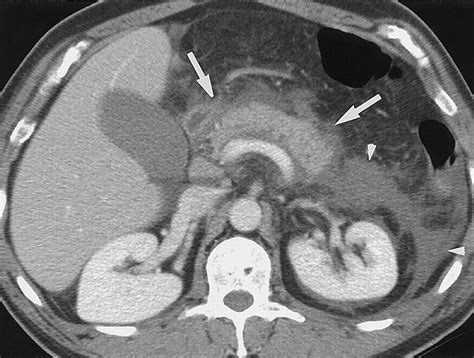 Disproportionate Fat Stranding: A Helpful CT Sign in Patients with ...