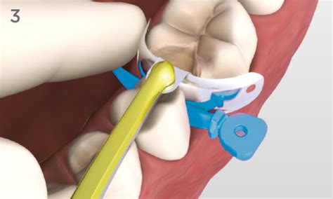 Palodent V3: Sectional Matrix System | Dentsply Sirona IN