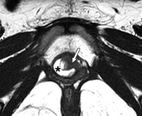 Pre- and Postoperative Evaluation of Urethral Diverticulum | AJR