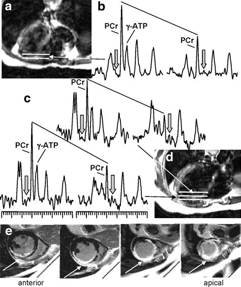 Reduced Myocardial Creatine Kinase Flux in Human Myocardial Infarction ...