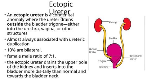 Disease of ureter and that of pelviureteric junction | PPT