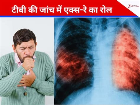 Chest X Ray of Tuberculosis Patient Near And Dear Is Not Enough The ...