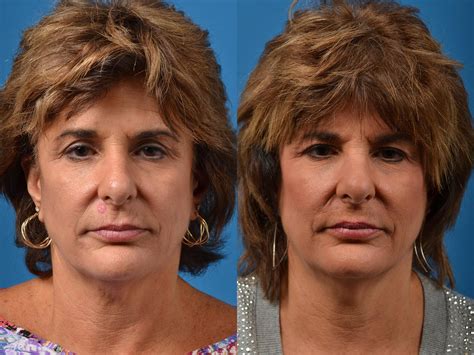 Patient 122406411 | Mohs Surgery and Skin Cancer Before & After Photos | Clevens Face and Body ...