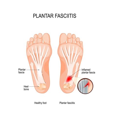 Shockwave Therapy for Plantar Fasciitis Treatment