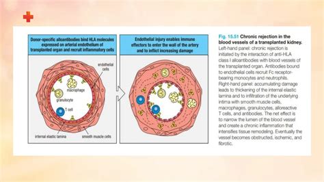 transplantation_and_rejection , classification of graft , rejection types and mechanism | PPT