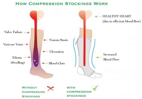 Compression Socks Benefits for Leg Health