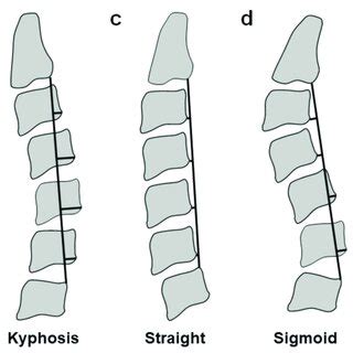 Illustration of disc-osteophyte complex size measurement. | Download ...