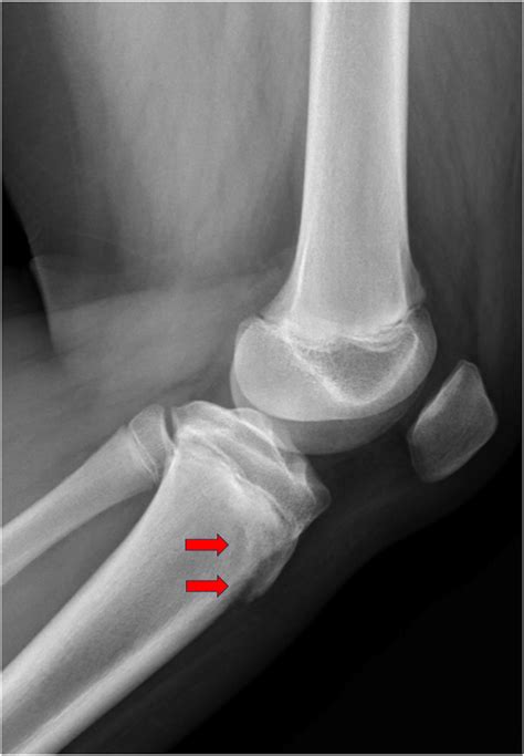 Adolescent Boy With Left Knee Pain While Running - Annals of Emergency Medicine
