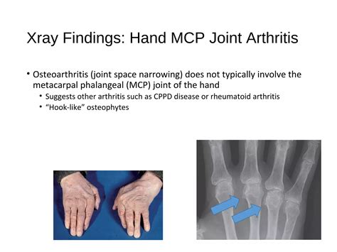 Crystal induced arthritis - Carlin | PPT