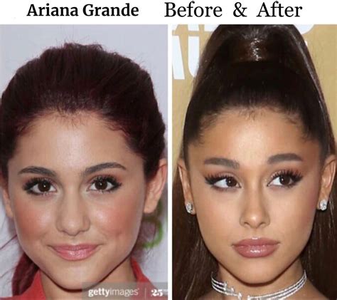 Ariana Grande - Before & After Plastic Surgery | Celebrity surgery ...