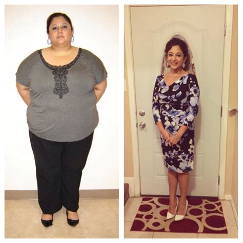 Weight Loss Surgery (Bariatric) Financing - CareCredit