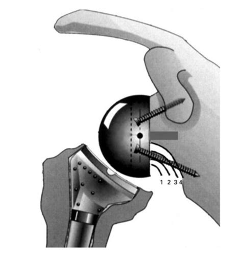 Lateralization in Reverse Shoulder Arthroplasty