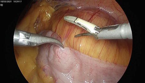 Image result for Nephrectomy Approach