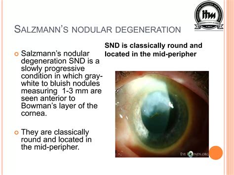 Salzmann Nodular Degeneration